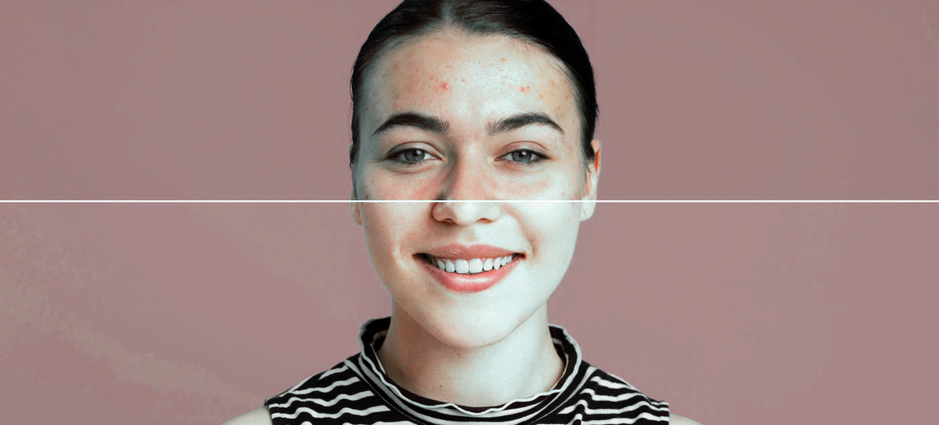 tratamiento antiacne malaga