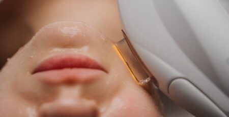 tratamiento facial con ipl