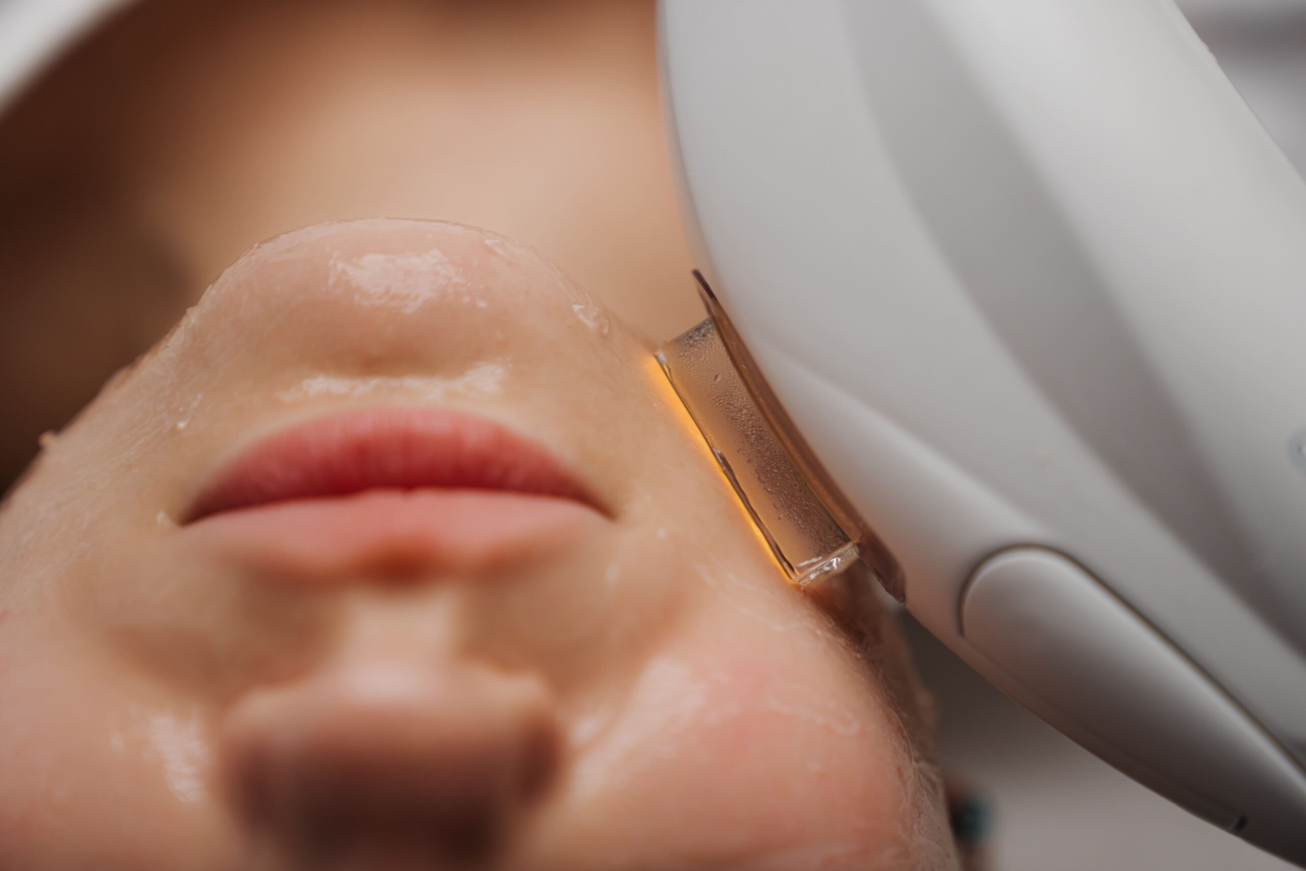 tratamiento facial con ipl