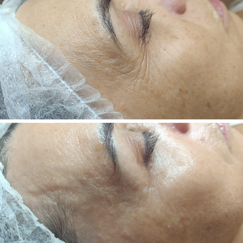 radiofrecuencia facial malaga 04
